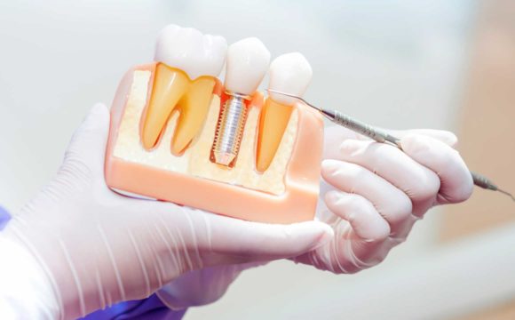 10 dúvidas comuns sobre implantes odontológicos