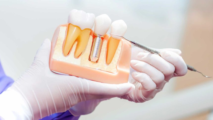 10 dúvidas comuns sobre implantes odontológicos